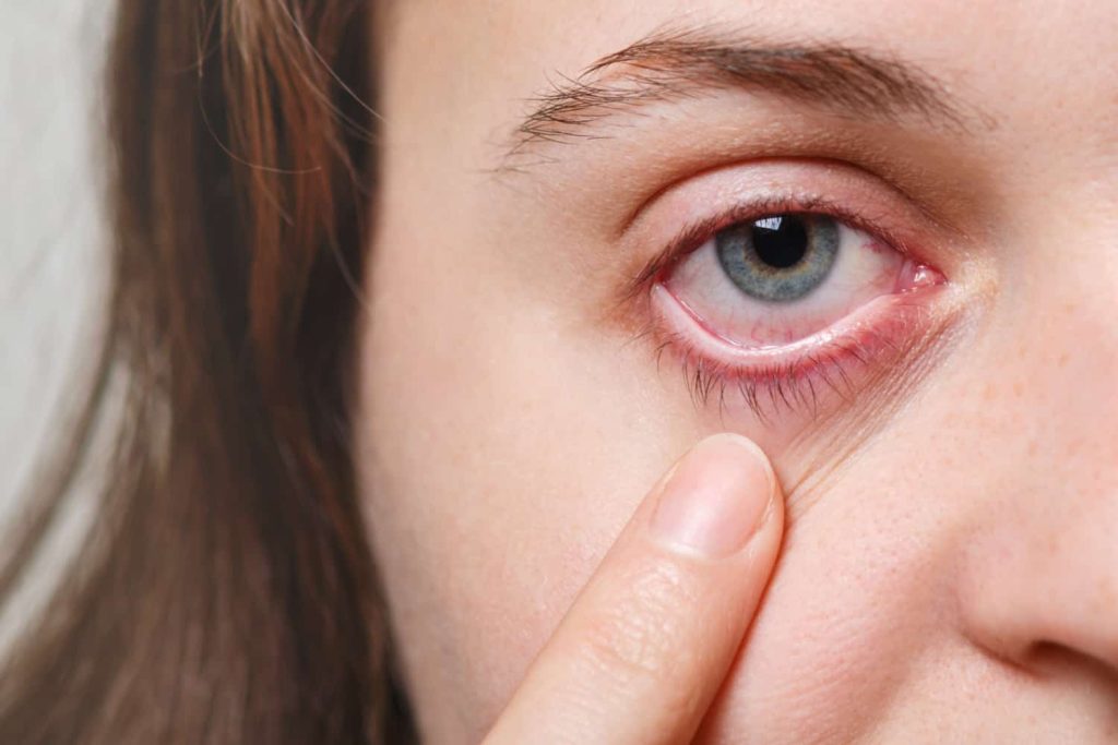 Does CBD Make Your Eyes Red